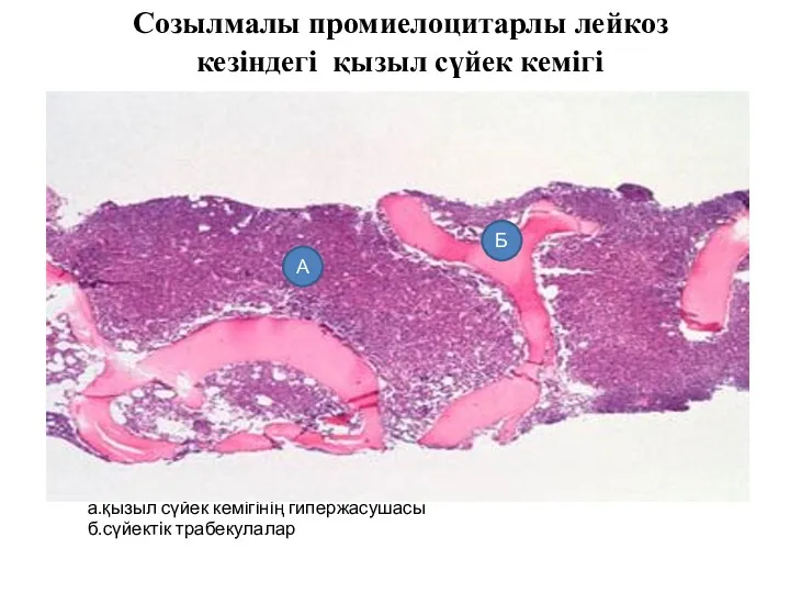 Созылмалы промиелоцитарлы лейкоз кезіндегі қызыл сүйек кемігі а.қызыл сүйек кемігінің гипержасушасы б.сүйектік трабекулалар А Б