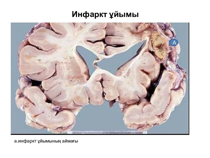 Инфаркт ұйымы а.инфаркт ұйымының аймағы А
