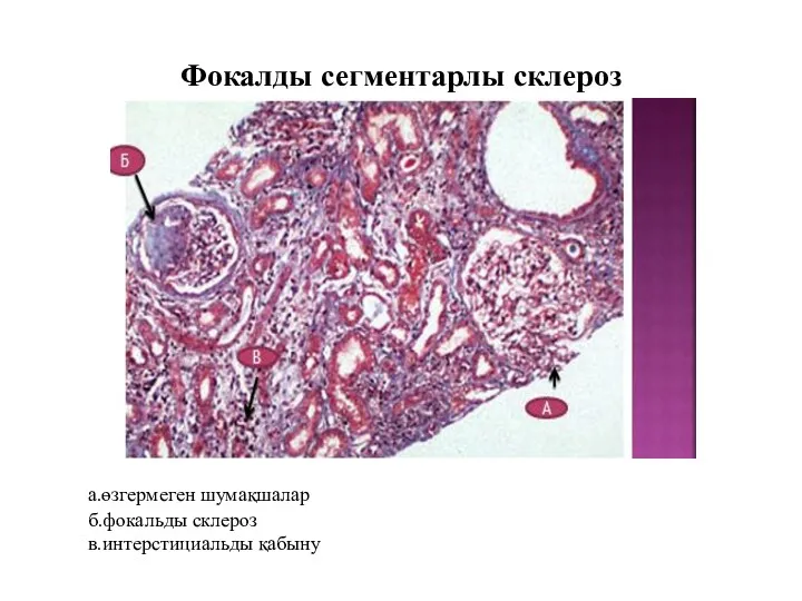 Фокалды сегментарлы склероз а.өзгермеген шумақшалар б.фокальды склероз в.интерстициальды қабыну