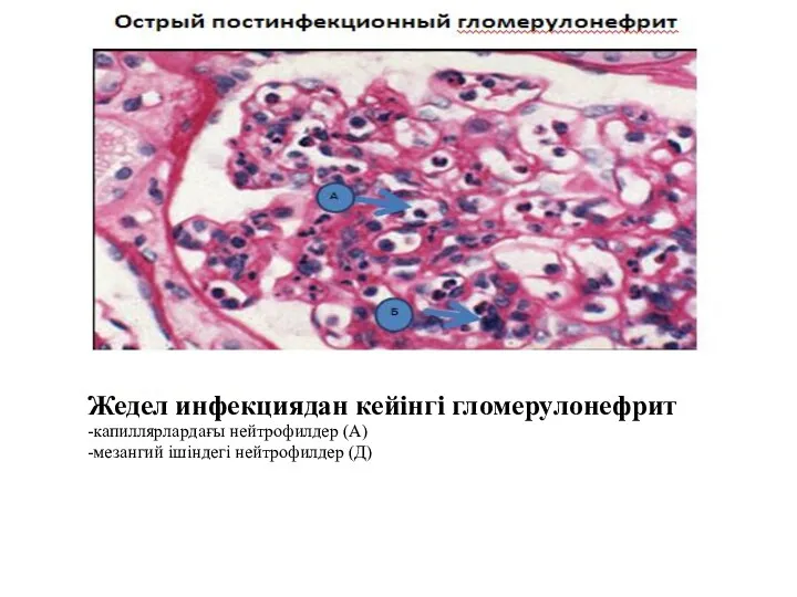 Жедел инфекциядан кейінгі гломерулонефрит -капиллярлардағы нейтрофилдер (А) -мезангий ішіндегі нейтрофилдер (Д)