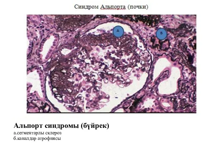 Альпорт синдромы (бүйрек) а.сегментарлы склероз б.каналдар атрофиясы