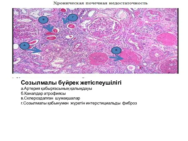 Созылмалы бүйрек жетіспеушілігі а.Артерия қабырғасының қалыңдауы б.Каналдар атрофиясы в.Склероздалған шумақшалар г.Созылмалы қабынумен жүретін интерстициальды фиброз