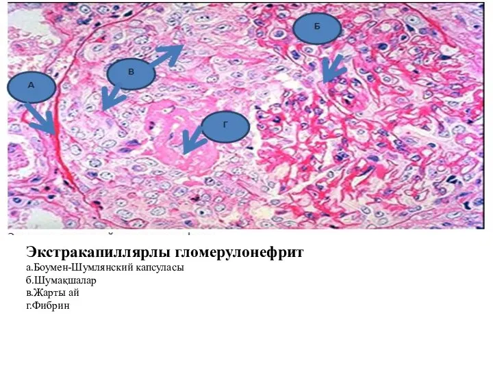 Экстракапиллярлы гломерулонефрит а.Боумен-Шумлянский капсуласы б.Шумақшалар в.Жарты ай г.Фибрин