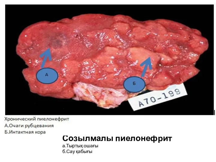 Созылмалы пиелонефрит а.Тыртық ошағы б.Сау қабығы