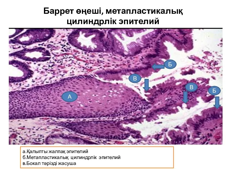 Баррет өңеші, метапластикалық цилиндрлік эпителий А Б Б В В