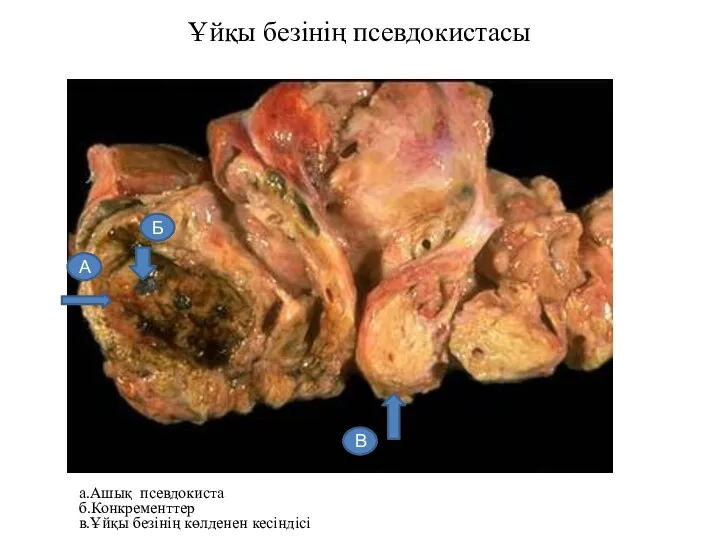 Ұйқы безінің псевдокистасы а.Ашық псевдокиста б.Конкременттер в.Ұйқы безінің көлденен кесіндісі Б В А