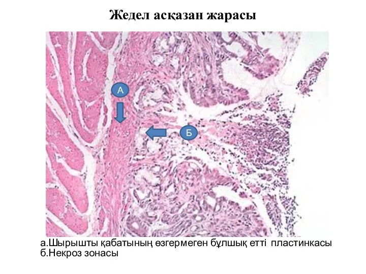 Жедел асқазан жарасы а.Шырышты қабатының өзгермеген бұлшық етті пластинкасы б.Некроз зонасы А Б