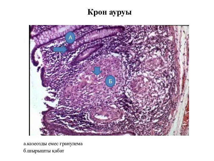 Крон ауруы а.казеозды емес гранулема б.шырышты қабат А Б
