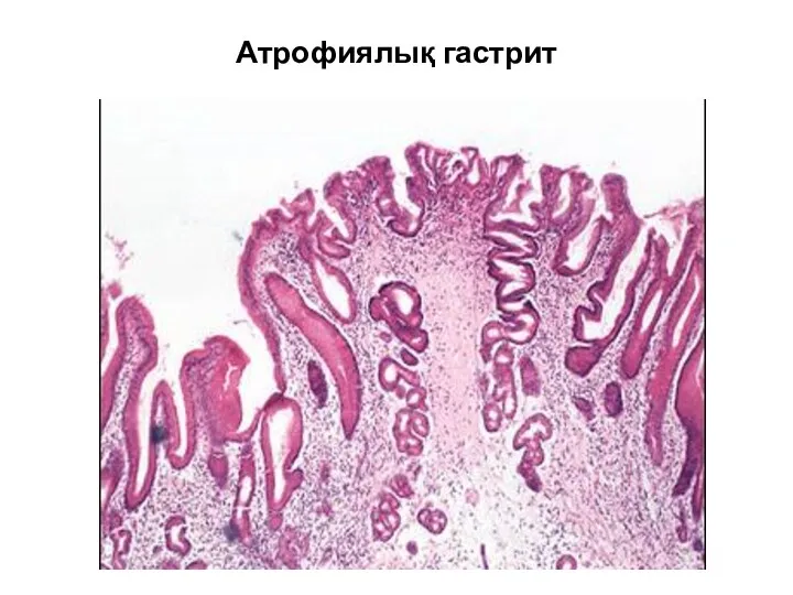 Атрофиялық гастрит