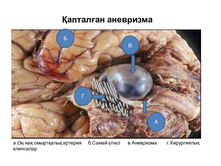 Қапталған аневризма а.Оң жақ омыртқалық артерия б.Самай үлесі в.Аневризма г.Хирургиялық клипсалар В Б А Г