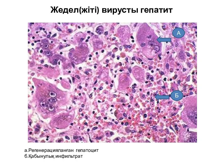 Жедел(жіті) вирусты гепатит а.Регенерацияланған гепатоцит б.Қабынулық инфильтрат А Б