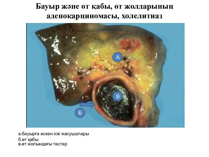 Бауыр және өт қабы, өт жолдарының аденокарциномасы, холелитиаз а.бауырға өскен ісік жасушалары б.өт