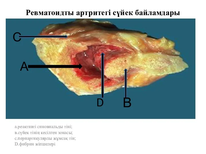 Ревматоидты артритегі сүйек байламдары а.реактивті синовиальды тіні; в.сүйек тінің кесілген зонасы; с.периартикулярлы жұмсақ