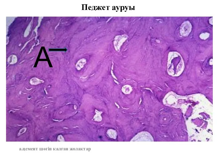 Педжет ауруы а.цемент шөгіп қалған жолақтар А