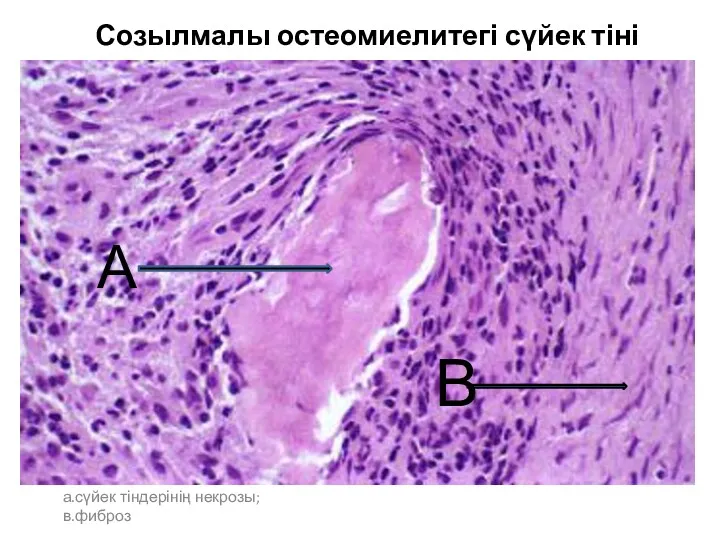 Созылмалы остеомиелитегі сүйек тіні а.сүйек тіндерінің некрозы; в.фиброз В А