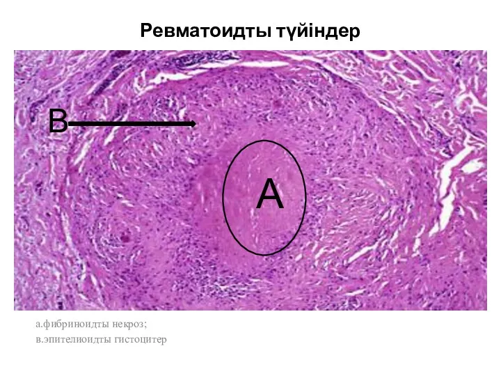 Ревматоидты түйіндер а.фибриноидты некроз; в.эпителиоидты гистоцитер А В