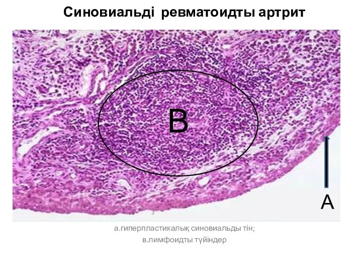 Синовиальді ревматоидты артрит а.гиперпластикалық синовиальды тін; в.лимфоидты түйіндер А В