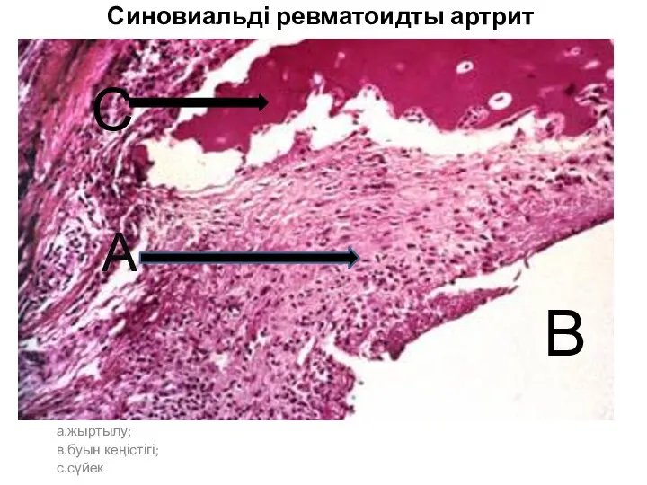 Синовиальді ревматоидты артрит а.жыртылу; в.буын кеңістігі; с.сүйек А В С