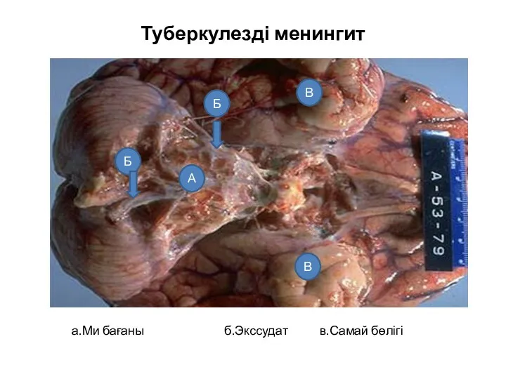 Туберкулезді менингит а.Ми бағаны б.Экссудат в.Самай бөлігі А Б Б В В