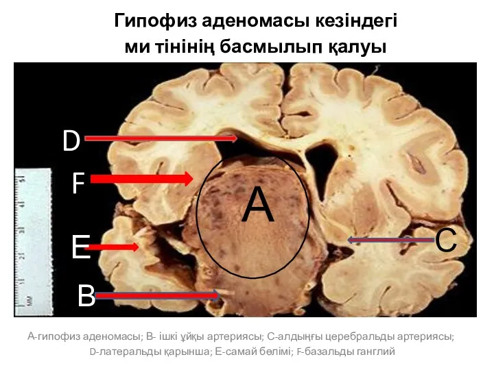 Гипофиз аденомасы кезіндегі ми тінінің басмылып қалуы А-гипофиз аденомасы; В- ішкі ұйқы артериясы;
