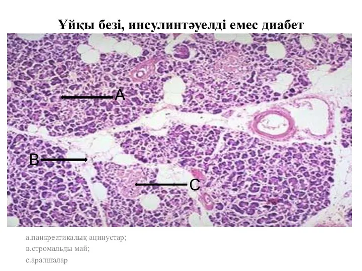 Ұйқы безі, инсулинтәуелді емес диабет а.панкреатикалық ацинустар; в.стромальды май; с.аралшалар А В С
