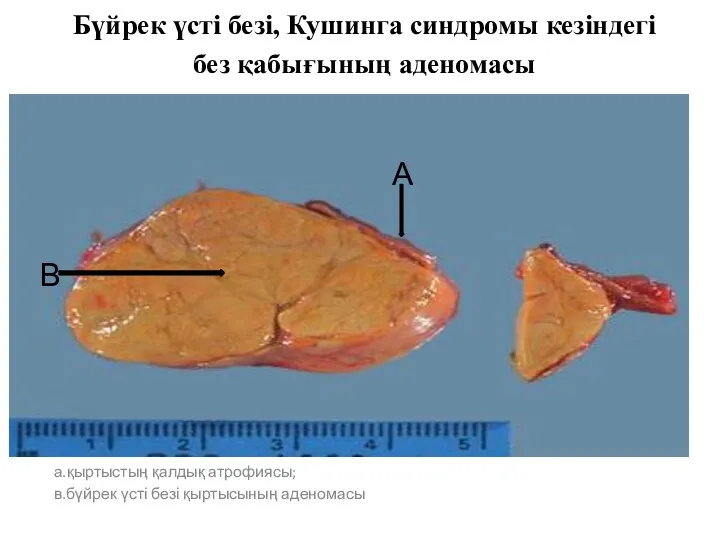 Бүйрек үсті безі, Кушинга синдромы кезіндегі без қабығының аденомасы а.қыртыстың қалдық атрофиясы; в.бүйрек