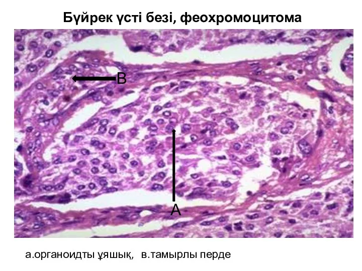 Бүйрек үсті безі, феохромоцитома а.органоидты ұяшық, в.тамырлы перде А В
