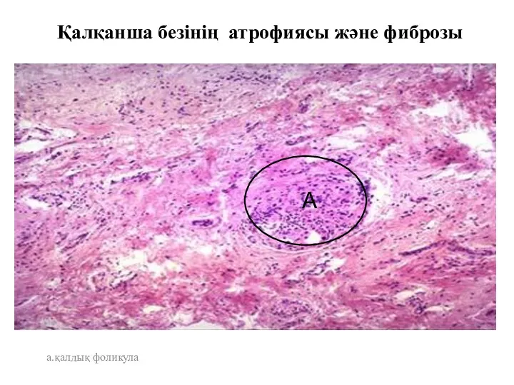 Қалқанша безінің атрофиясы және фиброзы а.қалдық фоликула А
