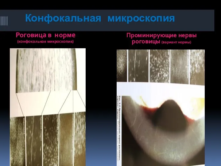 Конфокальная микроскопия Роговица в норме (конфокальная микроскопия) Проминирующие нервы роговицы (вариант нормы)