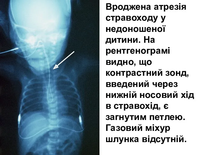 Вроджена атрезія стравоходу у недоношеної дитини. На рентгенограмі видно, що