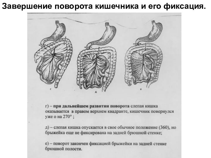 Завершение поворота кишечника и его фиксация.