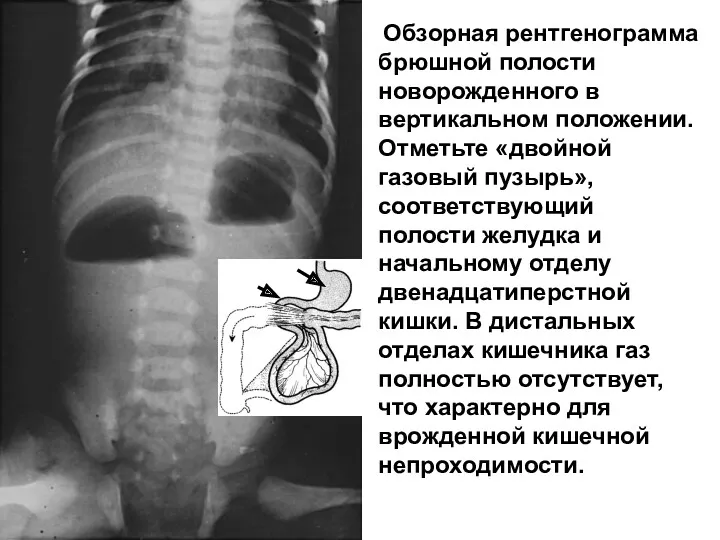 Обзорная рентгенограмма брюшной полости новорожденного в вертикальном положении. Отметьте «двойной