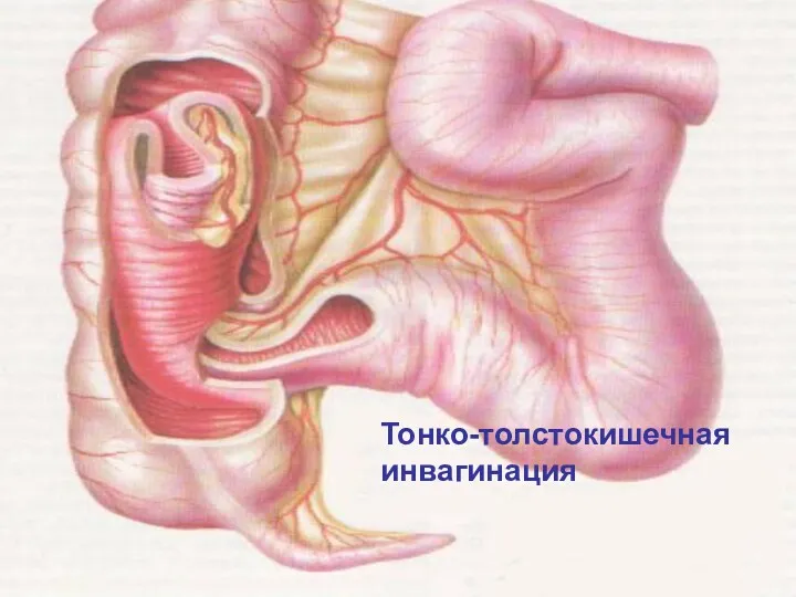 Тонко-толстокишечная инвагинация