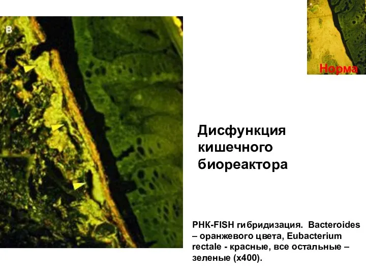 Норма Дисфункция кишечного биореактора РНК-FISH гибридизация. Bacteroides – оранжевого цвета,