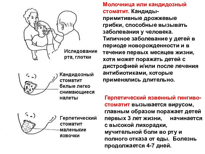 Молочница или кандидозный стоматит. Кандиды- примитивные дрожжевые грибки, способные вызывать