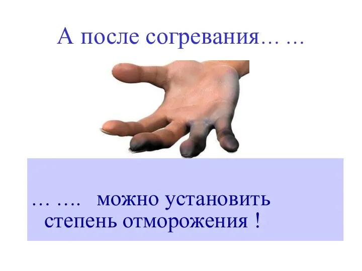 А после согревания… … … …. можно установить степень отморожения !