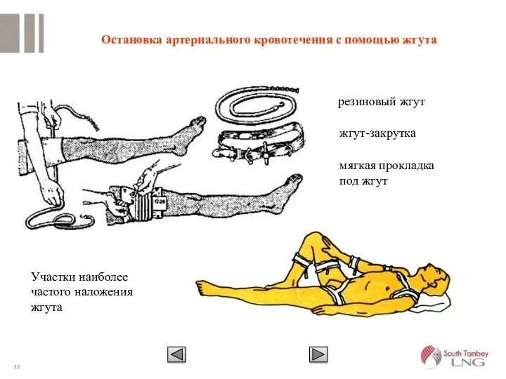 Остановка артериального кровотечения с помощью жгута резиновый жгут жгут-закрутка мягкая