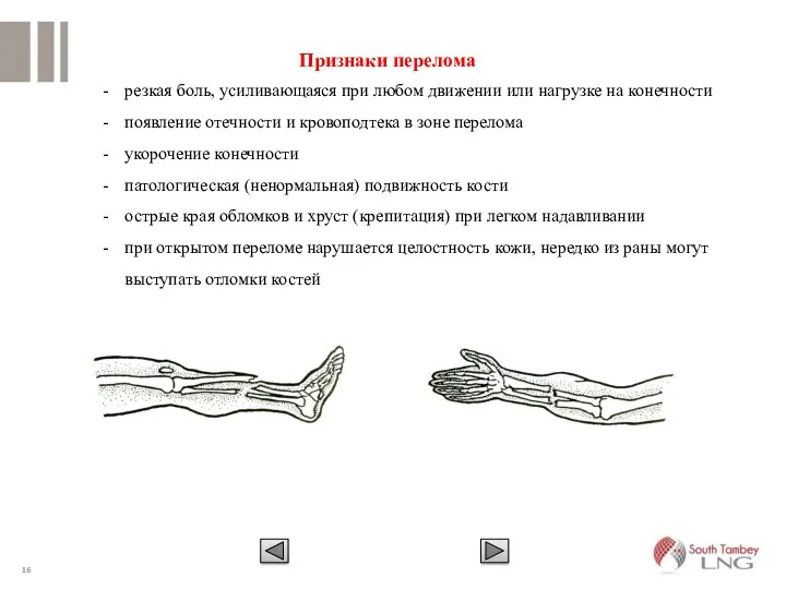 Признаки перелома резкая боль, усиливающаяся при любом движении или нагрузке