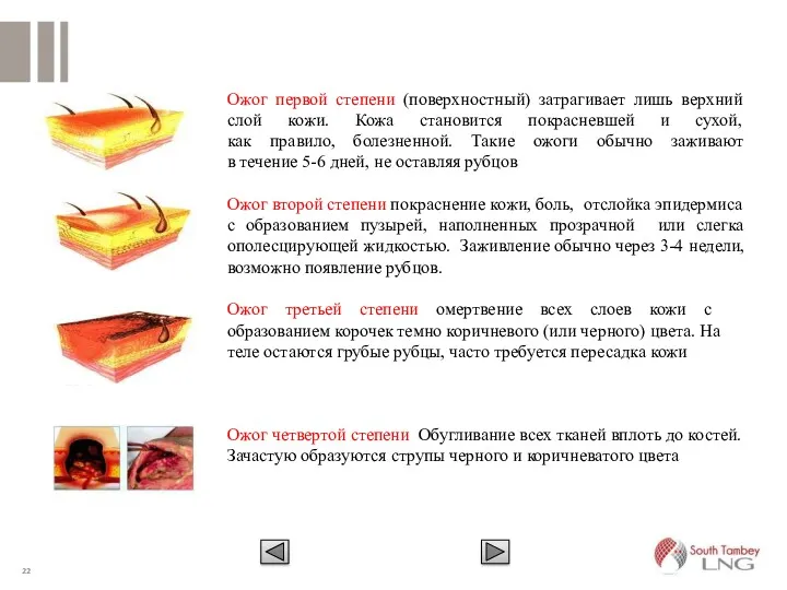 Ожог первой степени (поверхностный) затрагивает лишь верхний слой кожи. Кожа