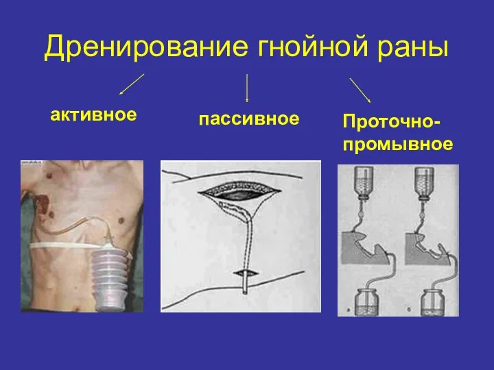 Дренирование гнойной раны активное пассивное Проточно- промывное