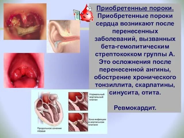 Приобретенные пороки. Приобретенные пороки сердца возникают после перенесенных заболеваний, вызванных