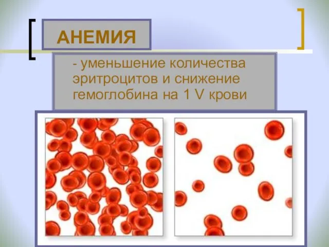 - уменьшение количества эритроцитов и снижение гемоглобина на 1 V крови АНЕМИЯ