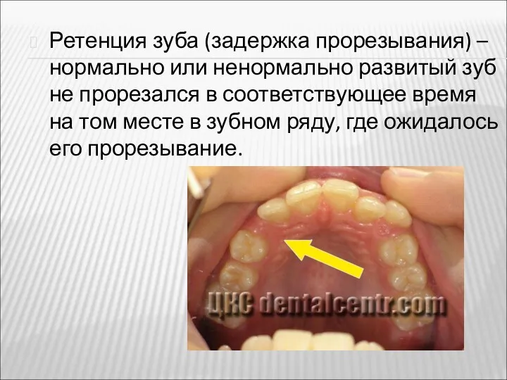 Ретенция зуба (задержка прорезывания) –нормально или ненормально развитый зуб не