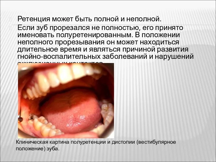 Ретенция может быть полной и неполной. Если зуб прорезался не