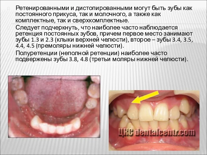 Ретенированными и дистопированными могут быть зубы как постоянного прикуса, так