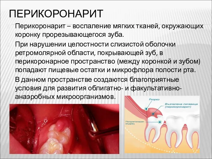 ПЕРИКОРОНАРИТ Перикоронарит – воспаление мягких тканей, окружающих коронку прорезывающегося зуба.