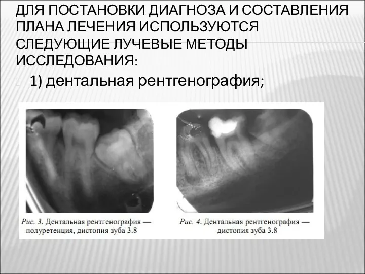 ДЛЯ ПОСТАНОВКИ ДИАГНОЗА И СОСТАВЛЕНИЯ ПЛАНА ЛЕЧЕНИЯ ИСПОЛЬЗУЮТСЯ СЛЕДУЮЩИЕ ЛУЧЕВЫЕ МЕТОДЫ ИССЛЕДОВАНИЯ: 1) дентальная рентгенография;