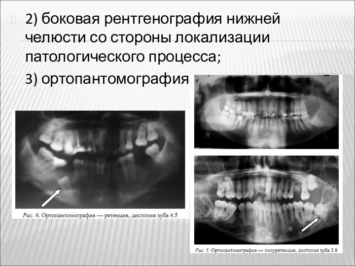 2) боковая рентгенография нижней челюсти со стороны локализации патологического процесса; 3) ортопантомография ;