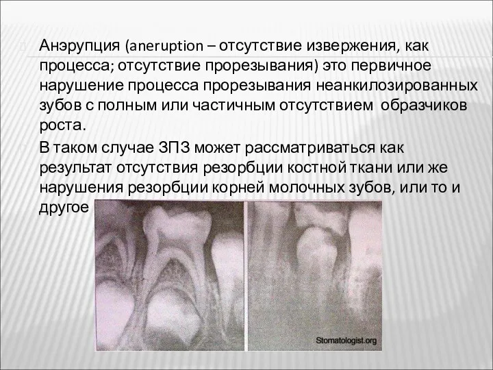 Анэрупция (aneruption – отсутствие извержения, как процесса; отсутствие прорезывания) это