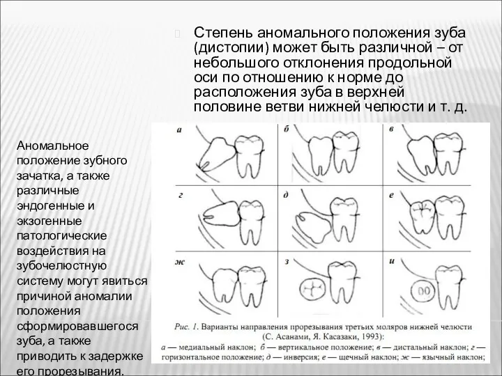 Аномальное положение зубного зачатка, а также различные эндогенные и экзогенные